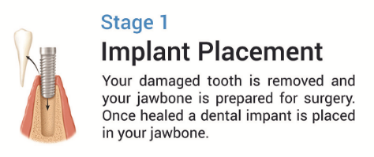 implant stage 1-272-121-349